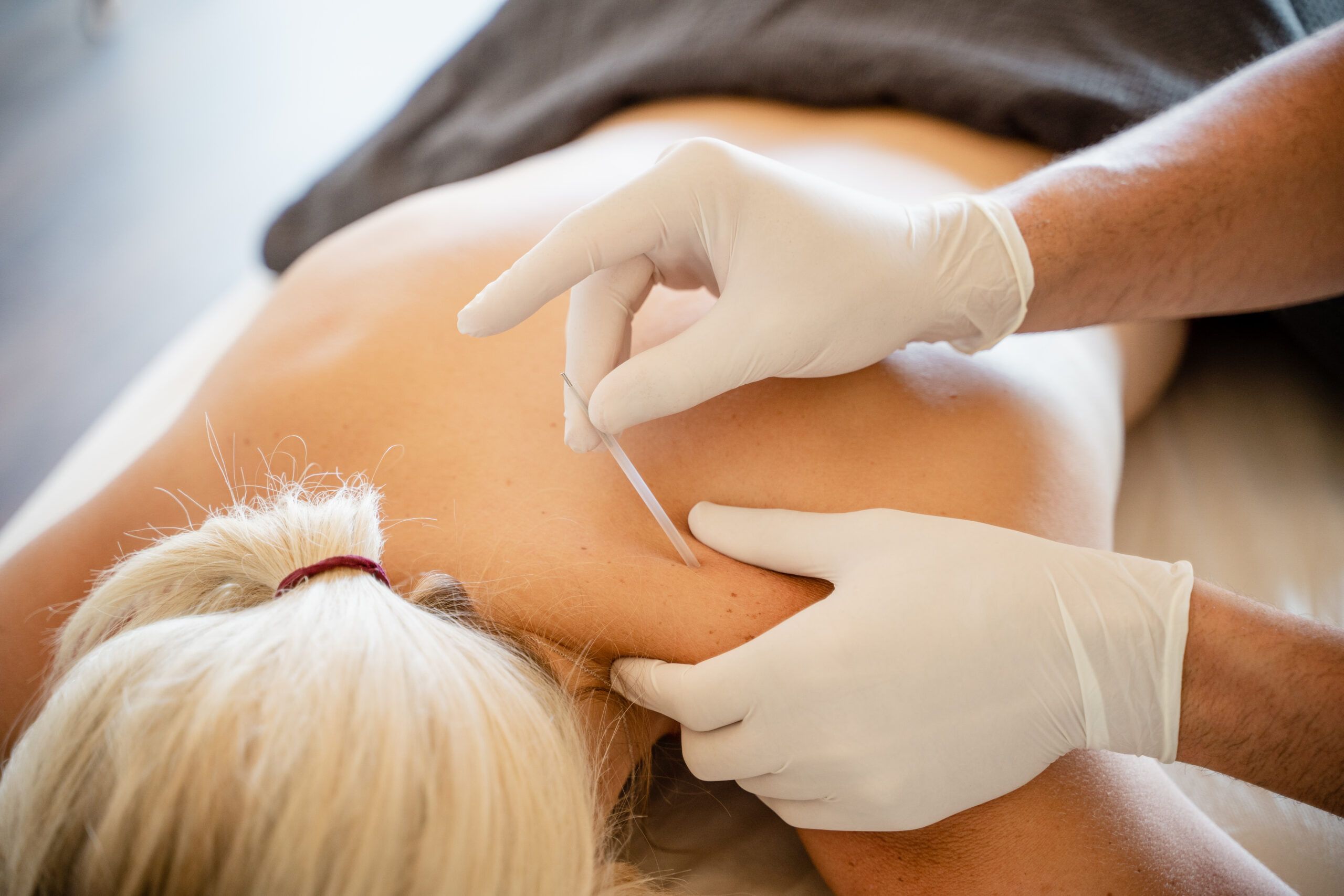 Fisioterapia manos punción seca clinica clínica de fisioterapia elche